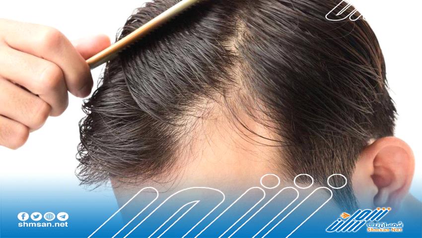 علماء يكتشفون طريقة للقضاء على الثعلبة وحل مشكلة تساقط الشعر 